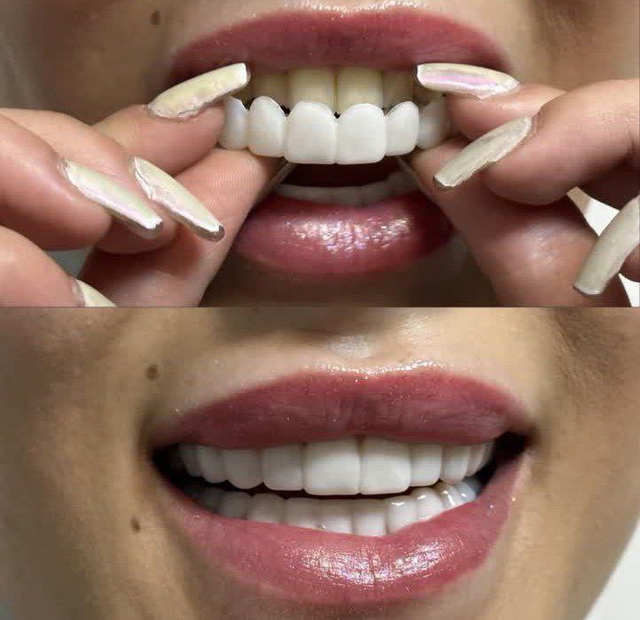  لمینت متحرک دندان دو فک با جایزه